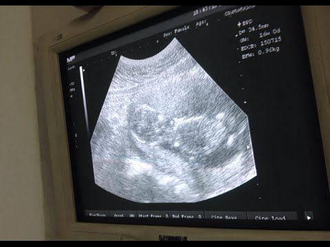 كيف تتجنبين أن يصاب طفلك أثناء الحمل بأي تشوه خلقي وكيف تتجنبين الإجهاض؟