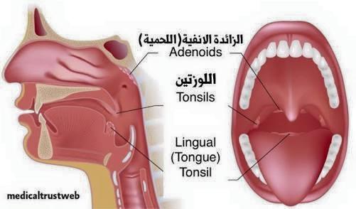 اللحمية عند الاطفال