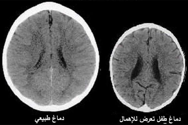 صور لدماغ طفلين بعمر ثلاث سنوات تظهر بوضوح تأثير الإهمال