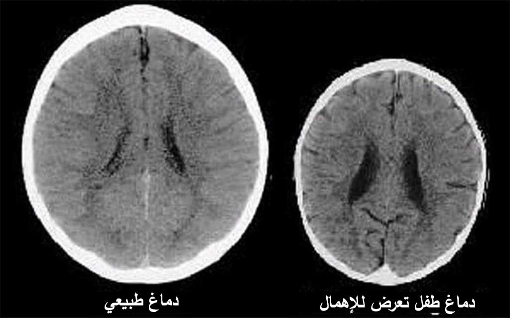 صور لدماغ طفلين بعمر ثلاث سنوات تظهر بوضوح تأثير الإهمال